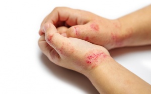 Hướng dẫn chăm sóc trẻ bị chốc lở tại nhà hiệu quả