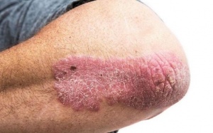 Triệu chứng điển hình của vảy nến thể mảng và cách cải thiện