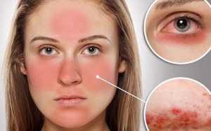 Lupus ban đỏ hệ thống có nguy hiểm không?