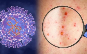 Bệnh đậu mùa khỉ hiếm gặp đang lây lan ở Châu Âu, Mỹ nguy hiểm thế nào?