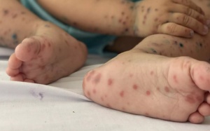 Dịch sốt xuất huyết, tay chân miệng gia tăng báo động tại TP.HCM