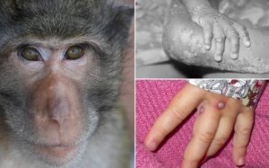 Việt Nam giám sát chặt bệnh đậu mùa khỉ, 4 triệu chứng sán lá gan nhỏ