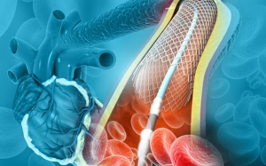 Bị tăng huyết áp, đái tháo đường đặt stent có khỏi hẳn bệnh mạch vành không?