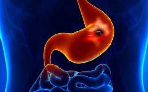 Chế độ dinh dưỡng cho người bị ung thư dạ dày