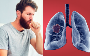 Một số dấu hiệu nhận biết ung thư phổi giai đoạn đầu 