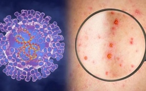 Bộ Y tế khuyến cáo 6 biện pháp phòng ngừa bệnh đậu mùa khỉ