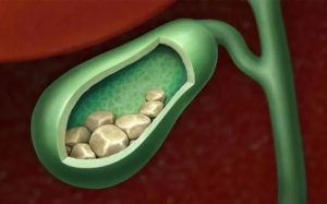 Sỏi túi mật 12,7mm nhưng chưa đau, dùng TPBVSK Kim Đởm Khang được không?