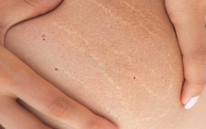 Làm thế nào để không còn nỗi ám ảnh với rạn da?