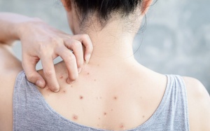 Hè đến, làm sao để giảm mụn lưng?