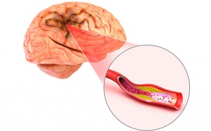 Dấu hiệu nhồi máu não và cách hỗ trợ điều trị hiệu quả