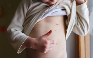 Những lưu ý quan trọng khi trị thủy đậu tại nhà 