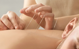 Châm cứu có những tác dụng gì? 