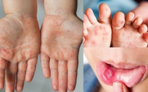 Nhận biết dấu hiệu bệnh tay chân miệng trở nặng