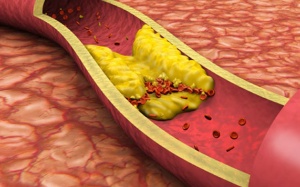 Thời tiết thất thường, người huyết áp, mỡ máu cao, tim mạch coi chừng bị xơ vữa động mạch 