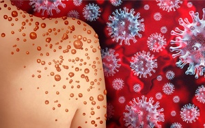 WHO xem xét công bố tình trạng khẩn cấp với bệnh đậu mùa khỉ