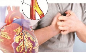 Xơ vữa động mạch: Nguyên nhân, điều trị và cách phòng tránh