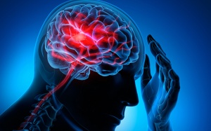 Hiểu về tắc mạch máu não để ngăn ngừa cơn đột quỵ