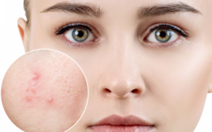 Những nguyên nhân gây ra mụn trứng cá có thể bạn chưa biết