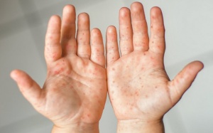 Cách phòng tránh bệnh tay chân miệng cho trẻ đơn giản và hiệu quả