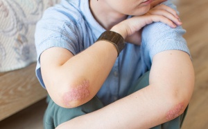 Cách bảo vệ hệ miễn dịch ở người bệnh vảy nến thể mảng