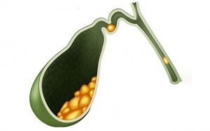 Sỏi mật 4,1mm có nhân là xác giun có nguy hiểm không?