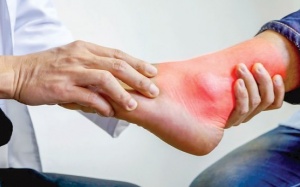 Bệnh nhân điều trị bệnh gout cần lưu ý gì?