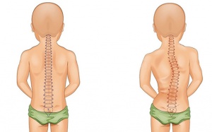 Cong vẹo cột sống ở lứa tuổi học đường và cách phòng tránh