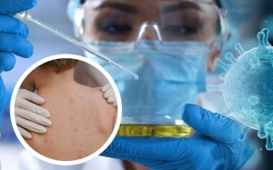 WHO cảnh báo lây nhiễm đậu mùa khỉ ở phụ nữ mang thai và trẻ em