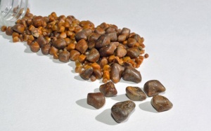 Sỏi mật 9mm có nguy hiểm không?