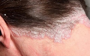 Vảy nến da đầu và tất tần tật những điều nên biết