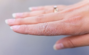 Mách bạn 5 cách chăm sóc da tay bị khô tại nhà