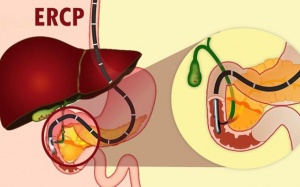 Sau nội soi mật tuỵ ngược dòng dùng TPBVSK Kim Đởm Khang được không?