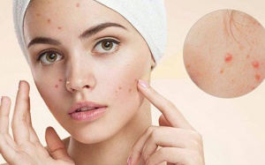 “Thủ phạm” gây mụn bọc ở mũi