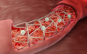 Làm sao để tránh tái tắc hẹp stent sau đặt?