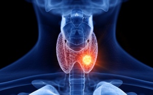 Triệu chứng của u tuyến giáp lành tính là gì? 