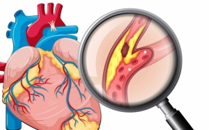 Giải pháp điều trị cho người bị hở van 2 lá, hẹp mạch vành 55%