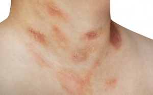 Biện pháp kiểm soát triệu chứng của bệnh vảy phấn hồng