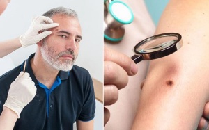 Dấu hiệu cảnh báo bệnh ung thư da bạn thường bỏ qua
