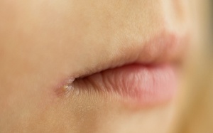 Bị chốc mép phải làm sao?