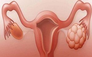 Các phương pháp điều trị u nang buồng trứng hiện nay