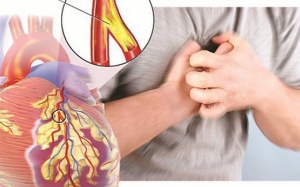 Tắc động mạch vành - Bệnh tim nguy hiểm có thể gặp ở mọi lứa tuổi