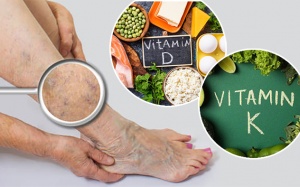 Thiếu vitamin D và K gây giãn tĩnh mạch, ảnh hưởng đến quá trình đông máu