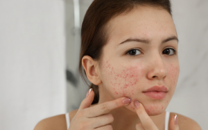 Mụn trứng cá: Hiểu rõ nguyên nhân gây mụn và cách điều trị