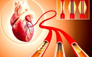 8 biến chứng sau khi đặt stent: Hiểu rõ để phòng ngừa rủi ro!