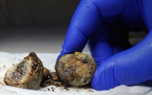 Sỏi mật bilirubin và những thông tin bạn nên biết