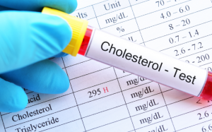 Lưu ý khi kiểm tra mức cholesterol