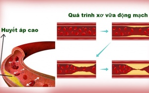 Huyết áp cao và xơ vữa động mạch có liên quan đến nhau như thế nào?