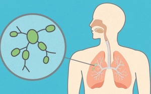 Biểu hiện và nguyên nhân ung thư phổi di căn hạch