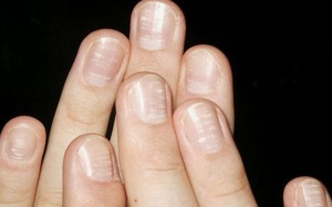 Vảy nến móng tay và các phương pháp điều trị bệnh hiện nay