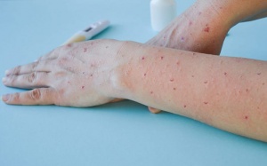 Ca bệnh đậu mùa khỉ đầu tiên tại nước ta có nguồn lây từ nước ngoài